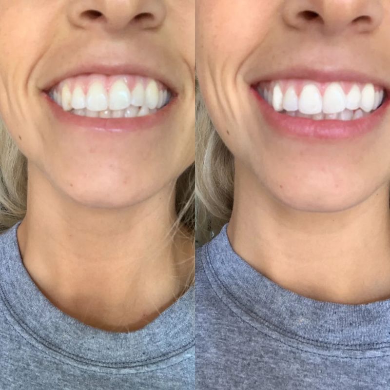 BVSA (26) Zestaw NanoSmile